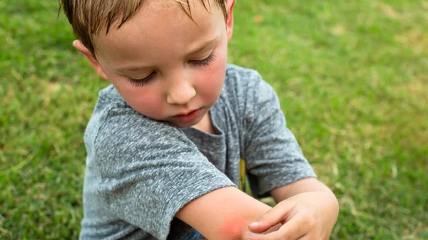 Πώς προστατεύουμε τα παιδιά από τα κουνούπια; Tips για φυσική αντιμετώπιση των τσιμπημάτων